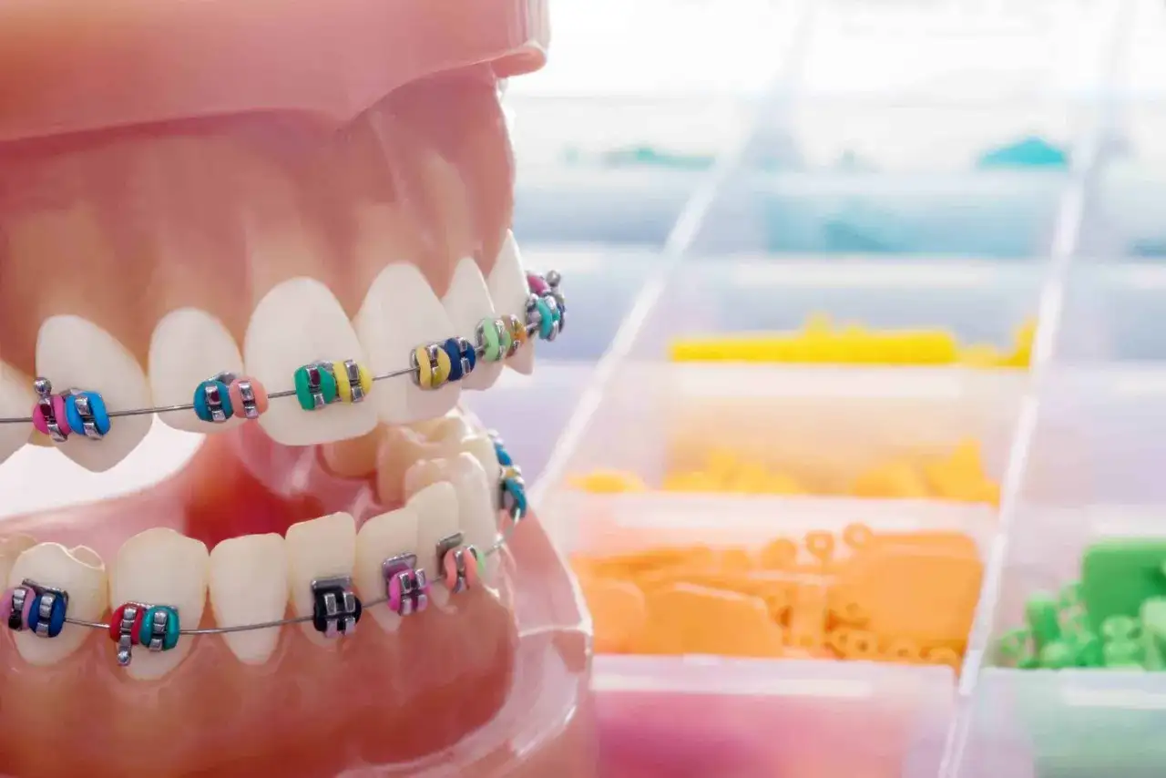 Ruchomy aparat ortodontyczny dziecka: Czy warto? Kompletny poradnik