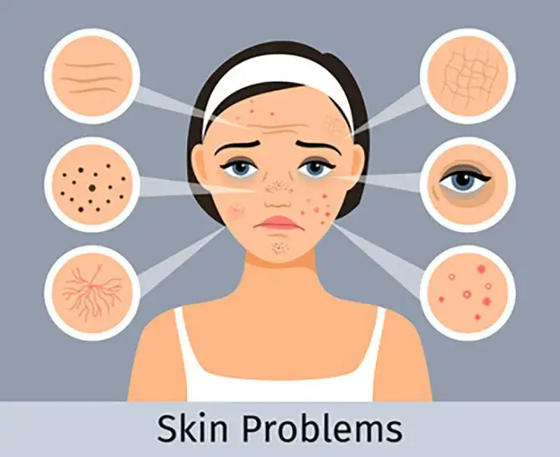 Jak pozbyć się śladów po pryszczach? Kompleksowy przewodnik