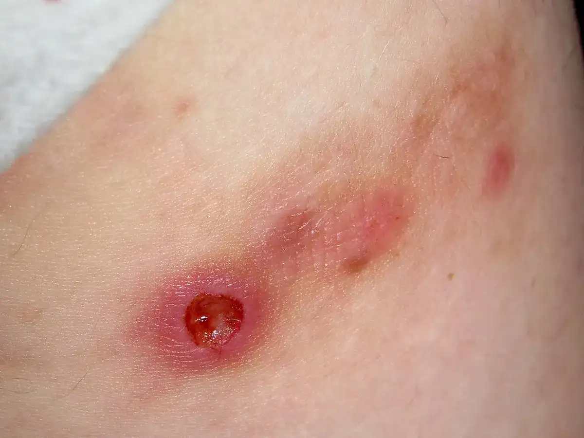 Rana po pryszczu, zaczerwienienie i strupek. Jak przyspieszyć gojenie?