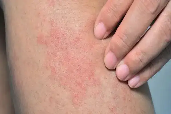 Masz krostki na nogach? Oto przyczyny i jak mieć gładką skórę