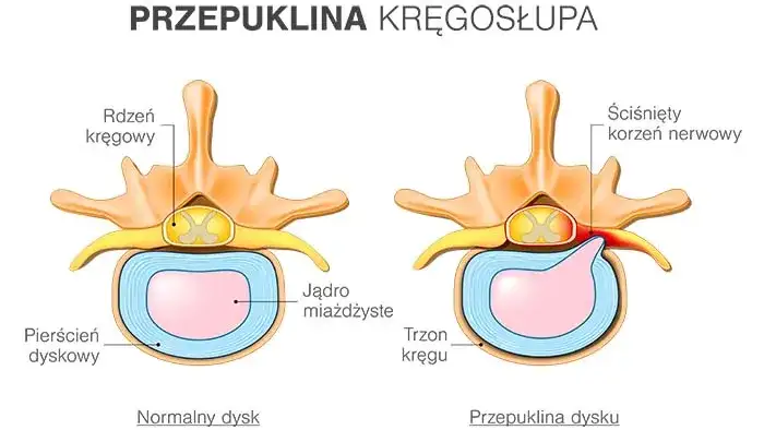 Przepuklina kręgosłupa piersiowego: niebagatelne objawy neurologiczne