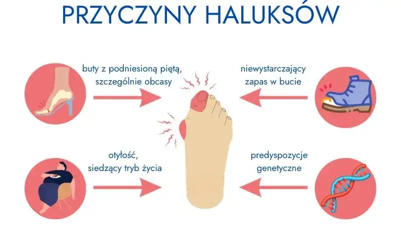 Haluksy dziedziczne? Jak zapobiegać, gdy masz predyspozycje