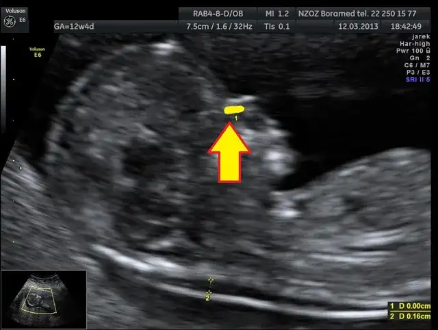 Czy na USG można wykryć zespół Downa? Kluczowe informacje i wskazówki