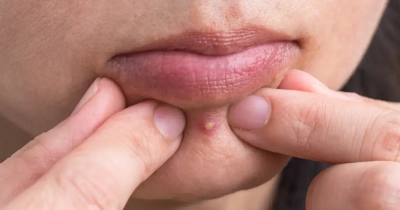 Dłonie uciskają skórę wokół ust, ukazując ropny pryszcz. Jak się pozbyć tego problemu?