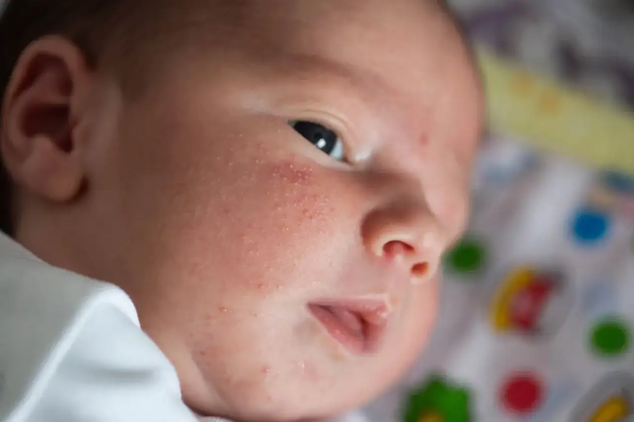 Potówki u niemowląt: Jak szybko ulżyć i skutecznie zapobiegać?