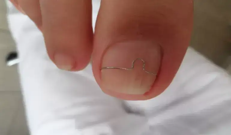 Dlaczego paznokcie u nóg rosną do góry? Poznaj przyczyny i rozwiązania