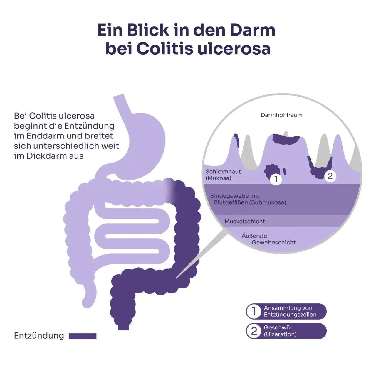 Colitis ulcerosa Symptome: Warnsignale, die Sie nicht ignorieren sollten