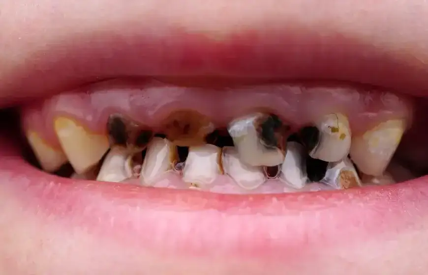 Jak wyleczyć próchnicę bez dentysty? Kiedy to możliwe?