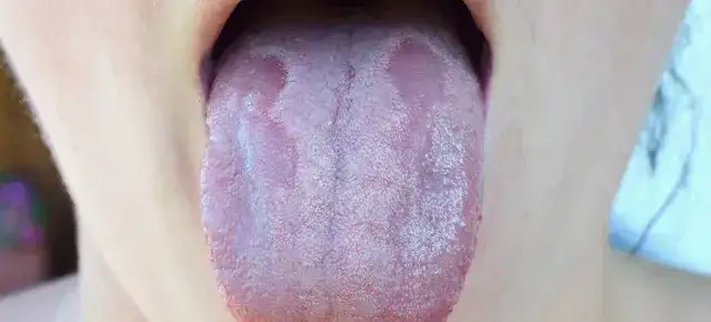 Candida objawy: 6 sygnałów ostrzegawczych w jelitach - sprawdź się