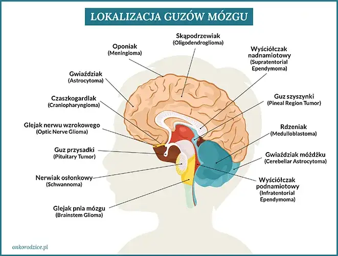 Czy to mogą być objawy guza mózgu? Zobacz, co powinieneś wiedzieć