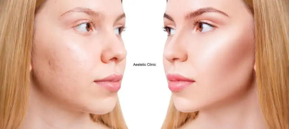 Jak szybko wyleczyć pryszcza? Skuteczne metody i uniknięcie blizn