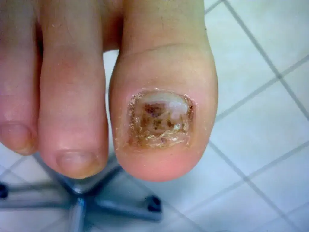 Odpadające paznokcie u nóg w snach: co oznaczają? Interpretacja