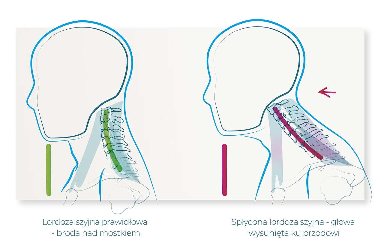 Ilustracja porównuje prawidłową lordozę szyjną z jej zniesieniem. Po prawej, zniesiona lordoza szyjna powoduje wysunięcie głowy do przodu.