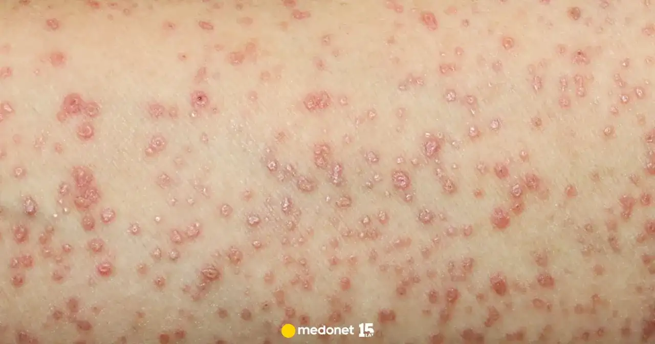 Liszaj płaski w ustach: objawy, przyczyny, leczenie i domowe sposoby