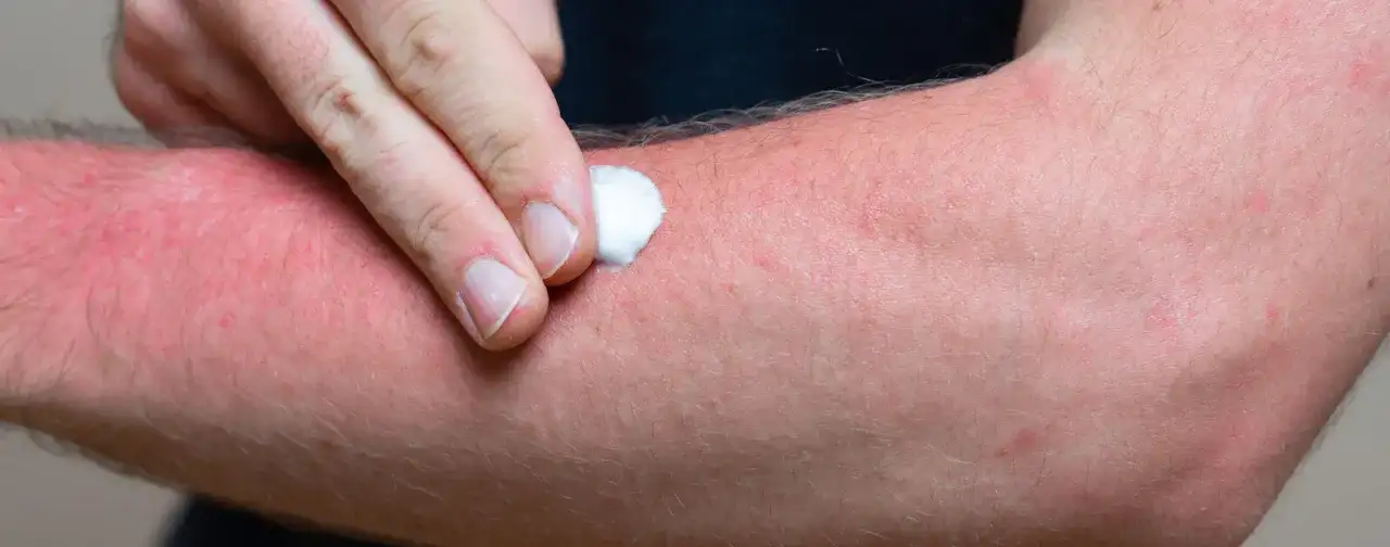 Rote, trockene Haut: Ursachen, Pflege & schnelle Linderung