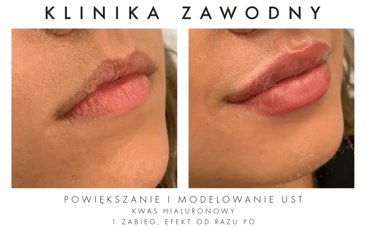 Kwas hialuronowy na usta: Nawilżenie czy powiększanie? Poznaj prawdę