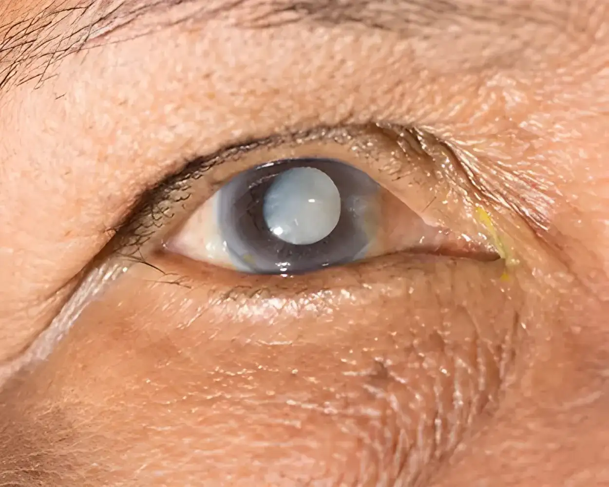 Grauen Star Symptome: Erkennen Sie die Anzeichen rechtzeitig