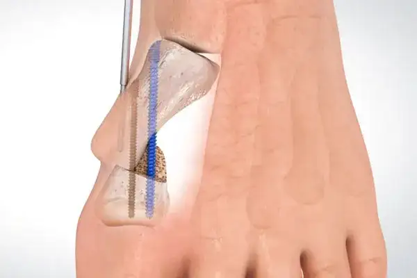 Znieczulenie do operacji haluksa: Wybierz komfort i bezpieczeństwo