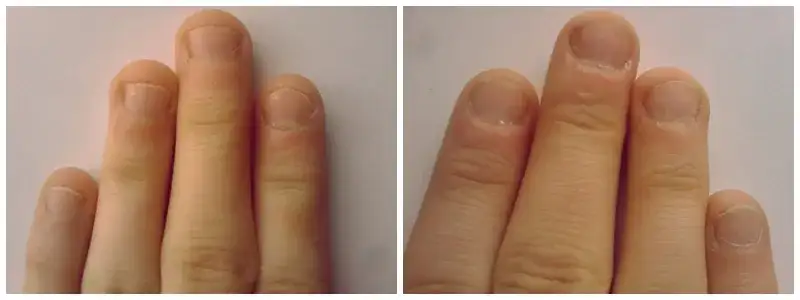 Jak skutecznie przestać obgryzać paznokcie i odzyskać zdrowe dłonie