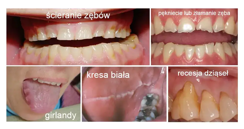 Płacz i zgrzytanie zębów: Czy bruksizm niszczy Twoje zęby?