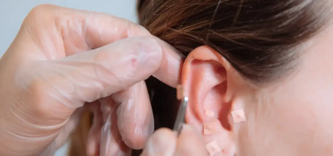 Akupunktura na rzucenie palenia: Czy to działa? Koszty, opinie.