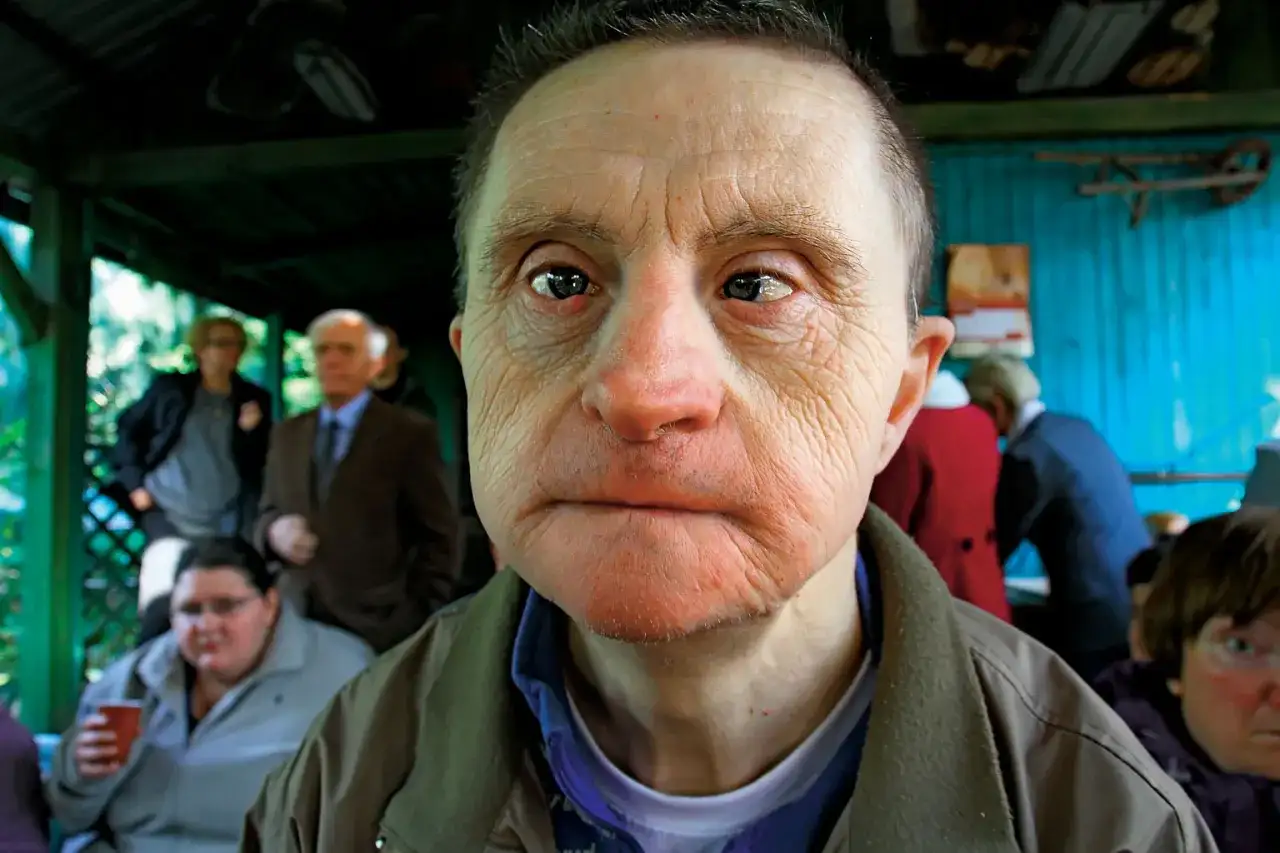 Jak długo żyją osoby z zespołem Downa? Zaskakujące statystyki życia