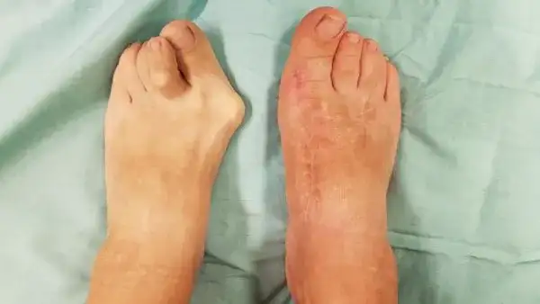 Kiedy operować haluksy? Ból, deformacja i leczenie zachowawcze