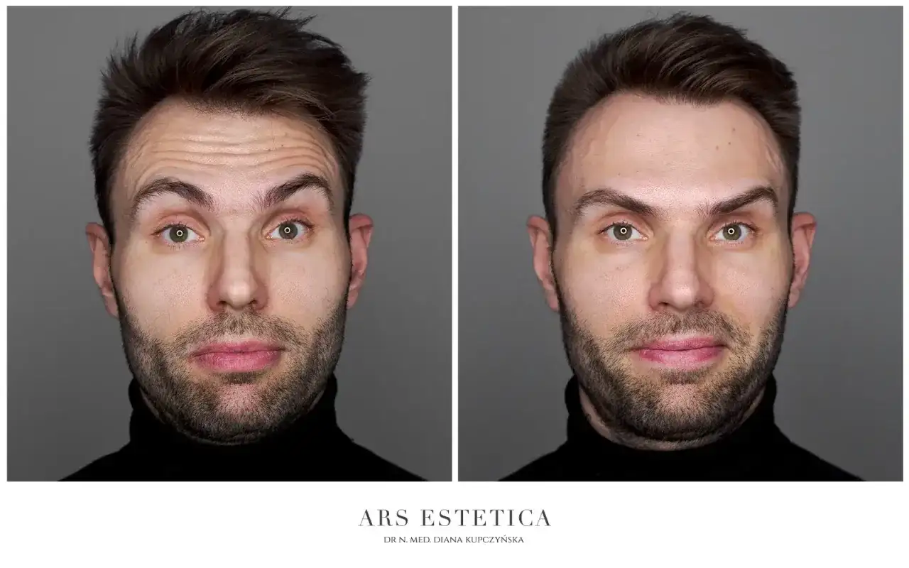 Złe efekty botoksu? Przyspiesz jego ustępowanie co naprawdę działa?