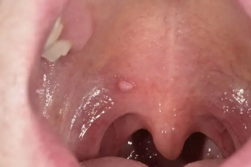 Objawy HPV w jamie ustnej: Jak rozpoznać i uniknąć poważnych problemów