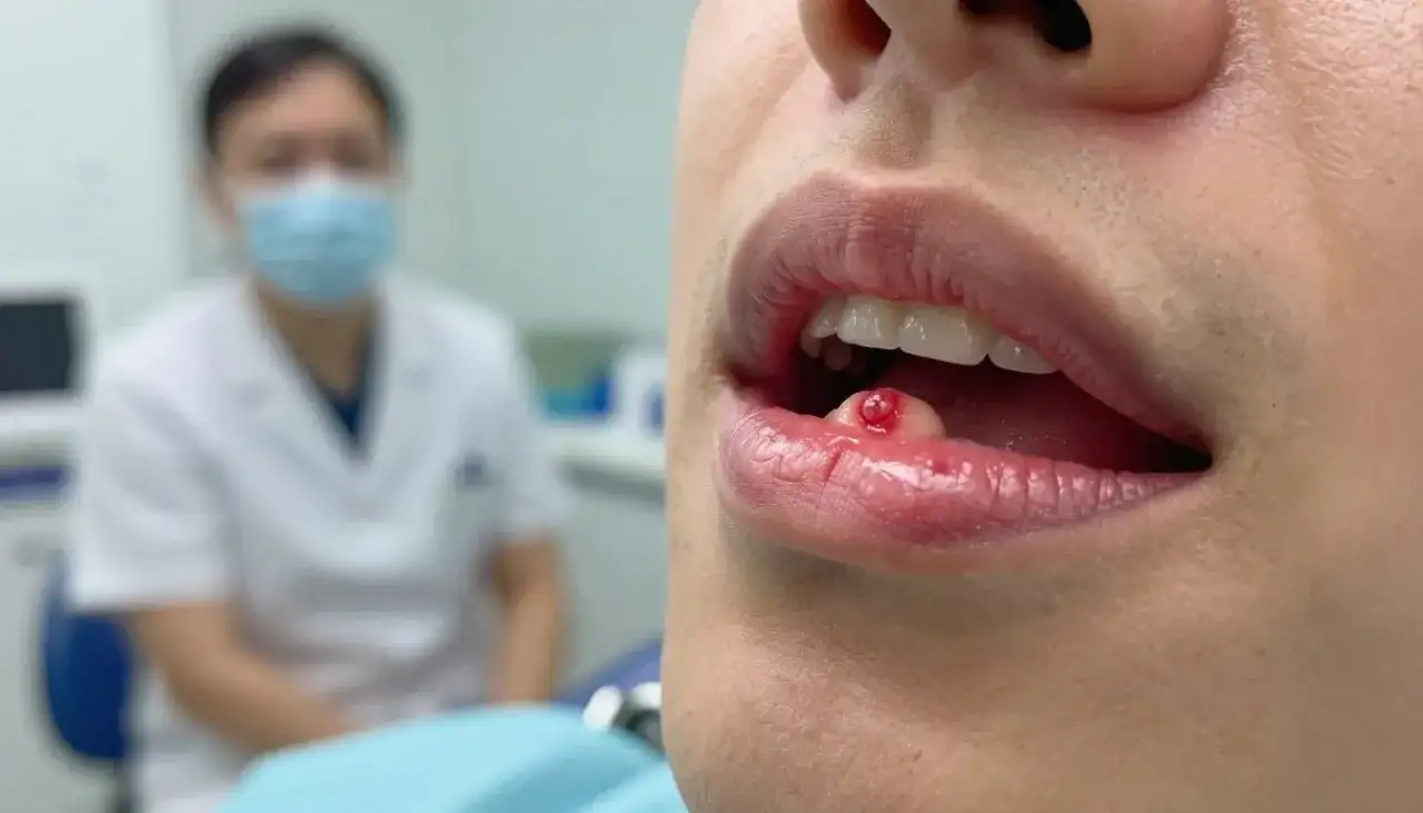 Afta na dziąśle: Skąd się bierze i jak szybko pozbyć się bólu?