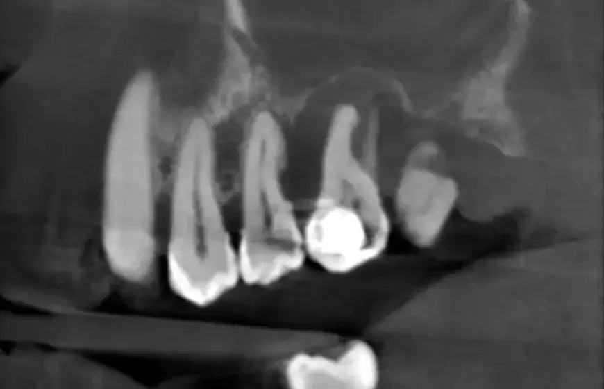 Zgorzel zęba objawy – jak je rozpoznać i uniknąć powikłań