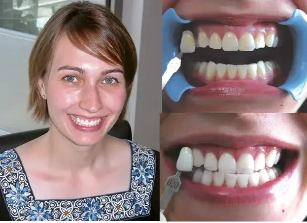 Wybielanie zębów u dentysty: Czy warto? Opinie, koszty, efekty