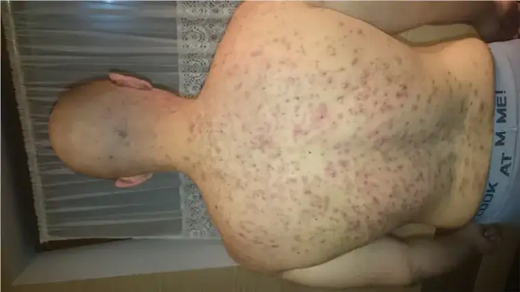 Jak skutecznie leczyć pryszcze po sterydach i odzyskać zdrową skórę