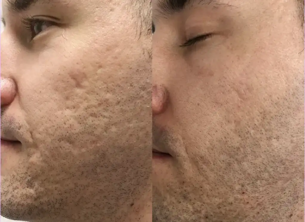 Laser frakcyjny nieablacyjny: Czy to najlepsza inwestycja w skórę?