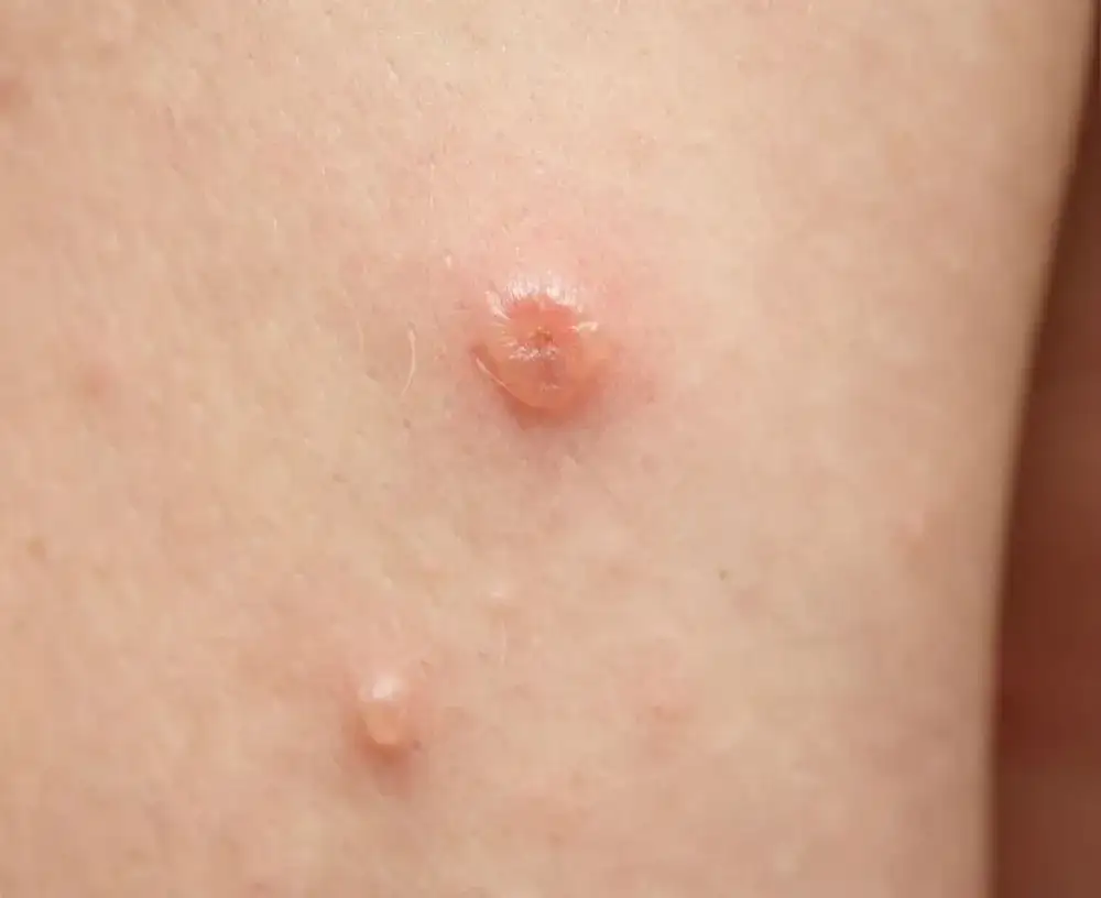 Guzek w pachwinie do jakiego lekarza? Poznaj ważne informacje zdrowotne