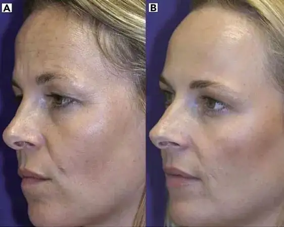 Nieudany botoks? Przyspiesz zanikanie i koryguj efekty