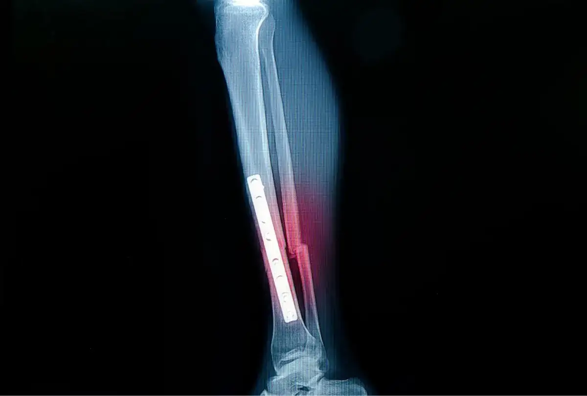 RTG pokazuje złamanie kości strzałkowej z zespoleniem płytą.