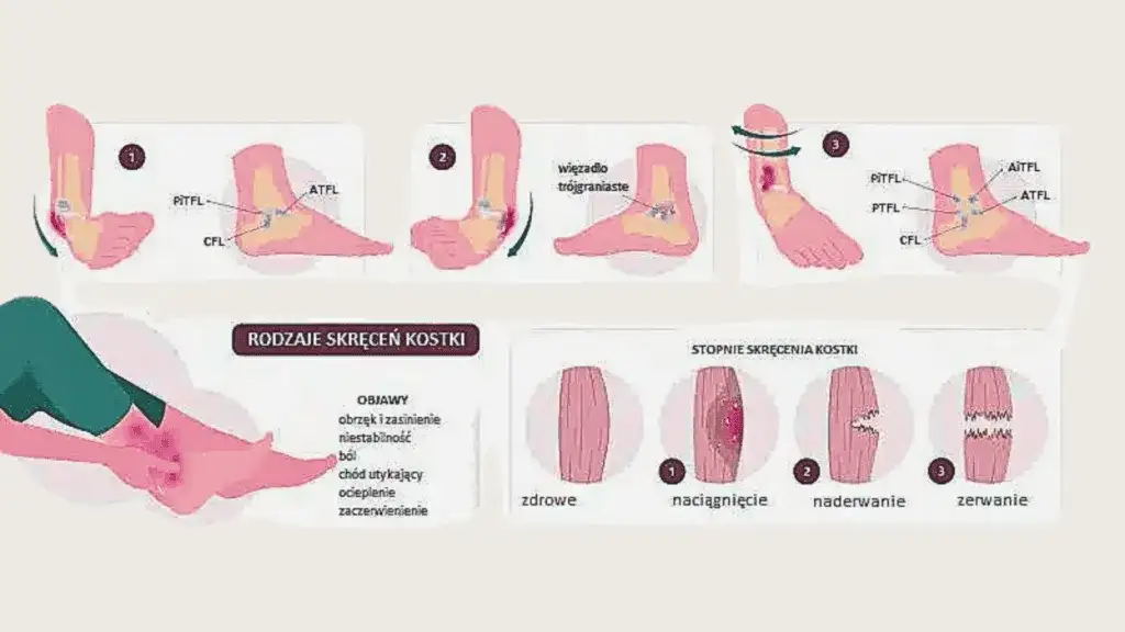 Jak skręcić nogę i uniknąć poważnych konsekwencji zdrowotnych