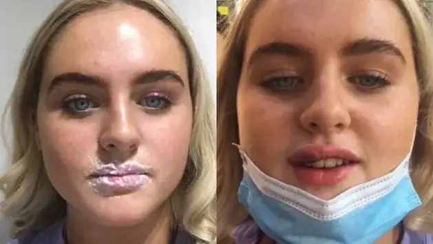 Alkohol po kwasie hialuronowym? Dlaczego to błąd i co tracisz?