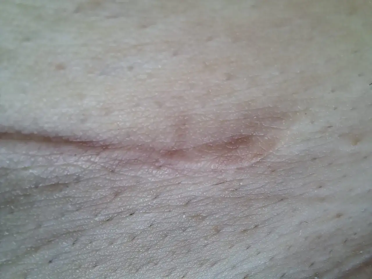 Zbliżenie na gojący się strupek na skórze z widocznymi porami i włoskami.