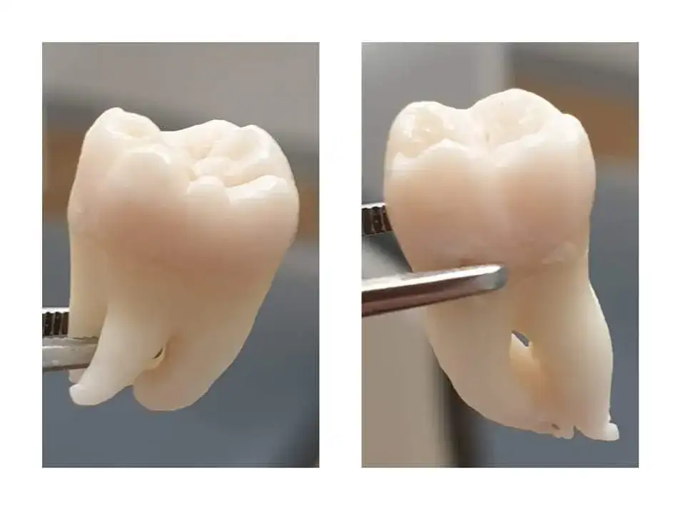 Zęby trzonowe – jakie to zęby i dlaczego są tak ważne dla zdrowia?
