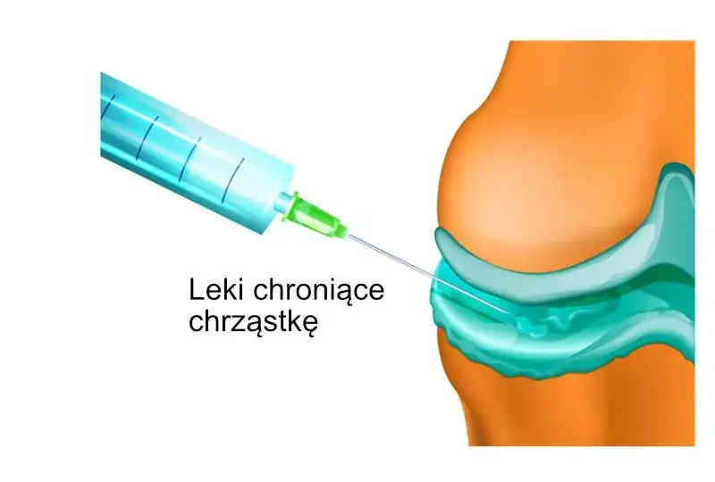 Jakie leki na zwyrodnienie stawu kolanowego skutecznie łagodzą ból?
