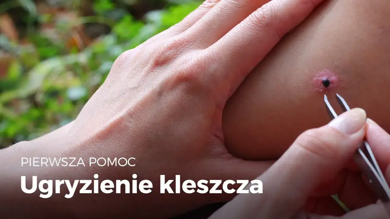 Jak wygląda miejsce po kleszczu? Objawy, które mogą zaskoczyć