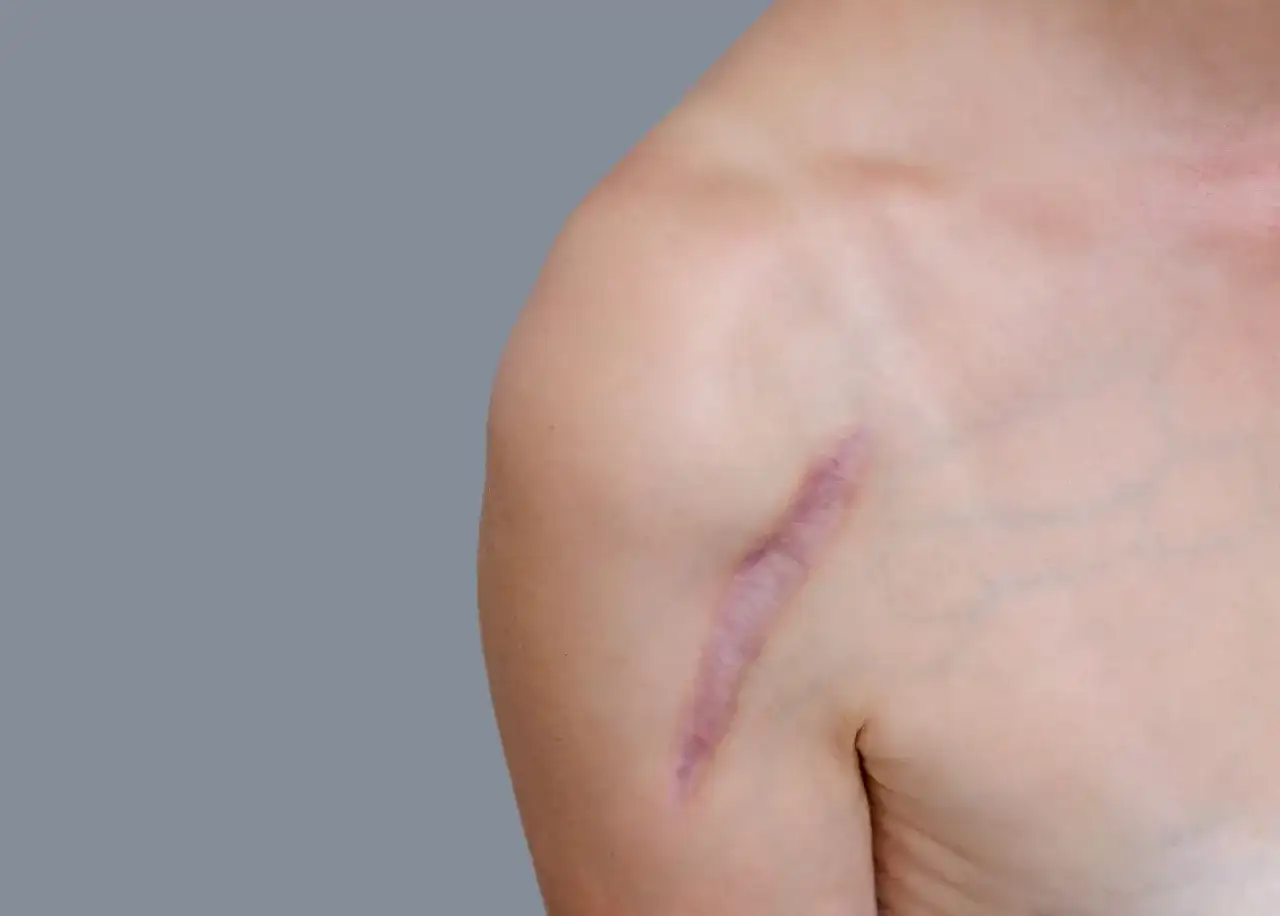 Jak szybko zagoić ranę po pryszczu? Koniec z bliznami i śladami!