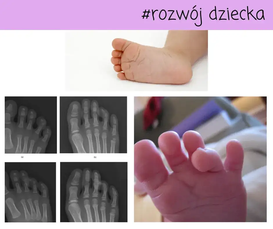 Krzywe palce u nóg dziecka - przyczyny i skuteczne leczenie