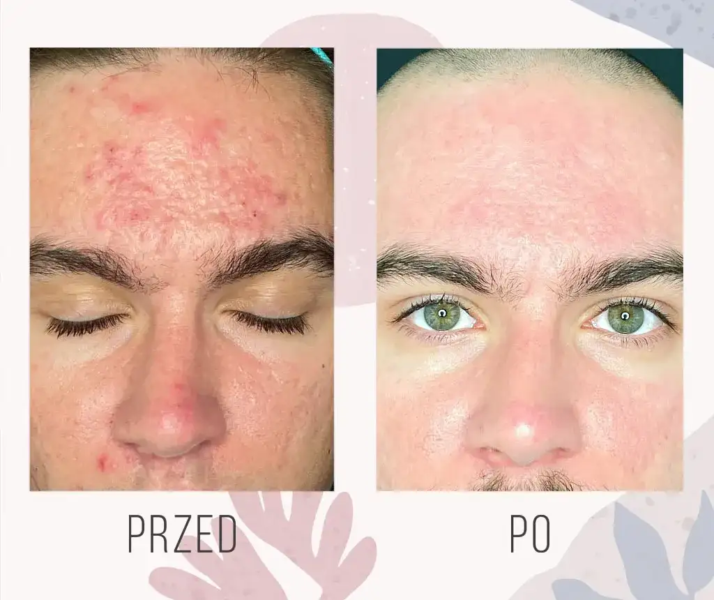 Jakie badania zrobić aby wyleczyć trądzik i poprawić stan skóry