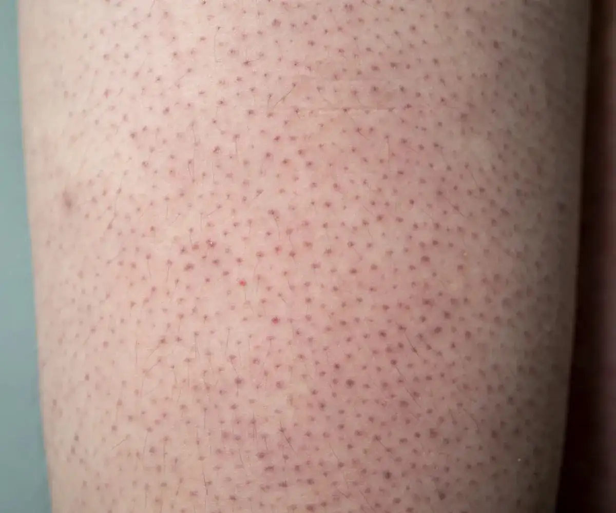 Jak pozbyć się czarnych kropek po goleniu - skuteczne metody i porady