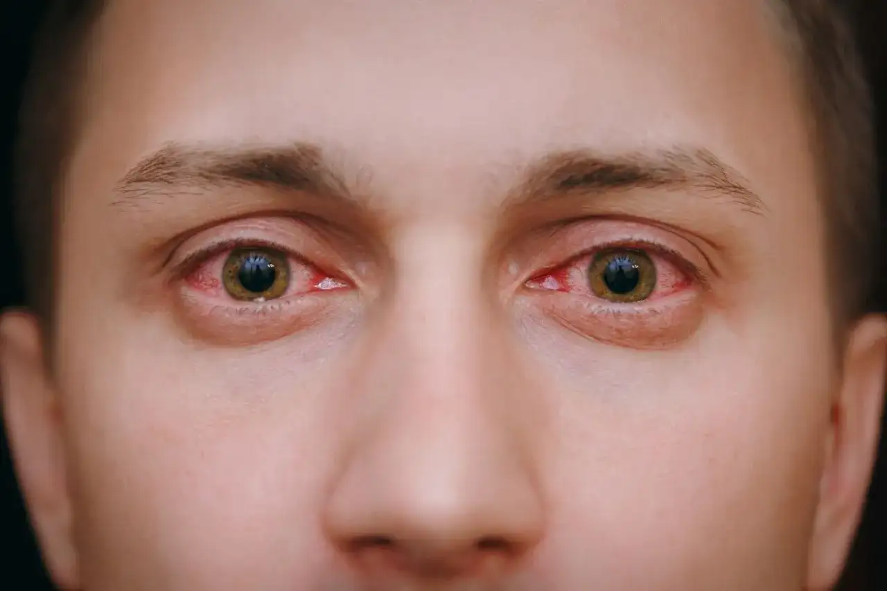 Przekrwione oczy przyczyny: poznaj, co może je powodować i jak leczyć