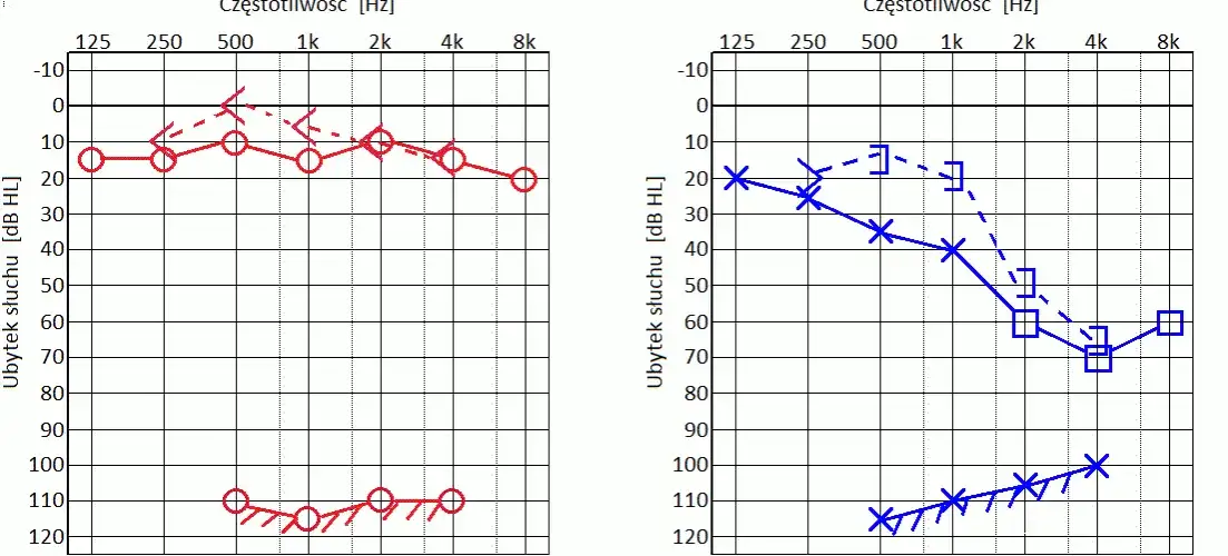 Audiogram - jak wygląda badanie słuchu i ile faktycznie trwa u specjalisty