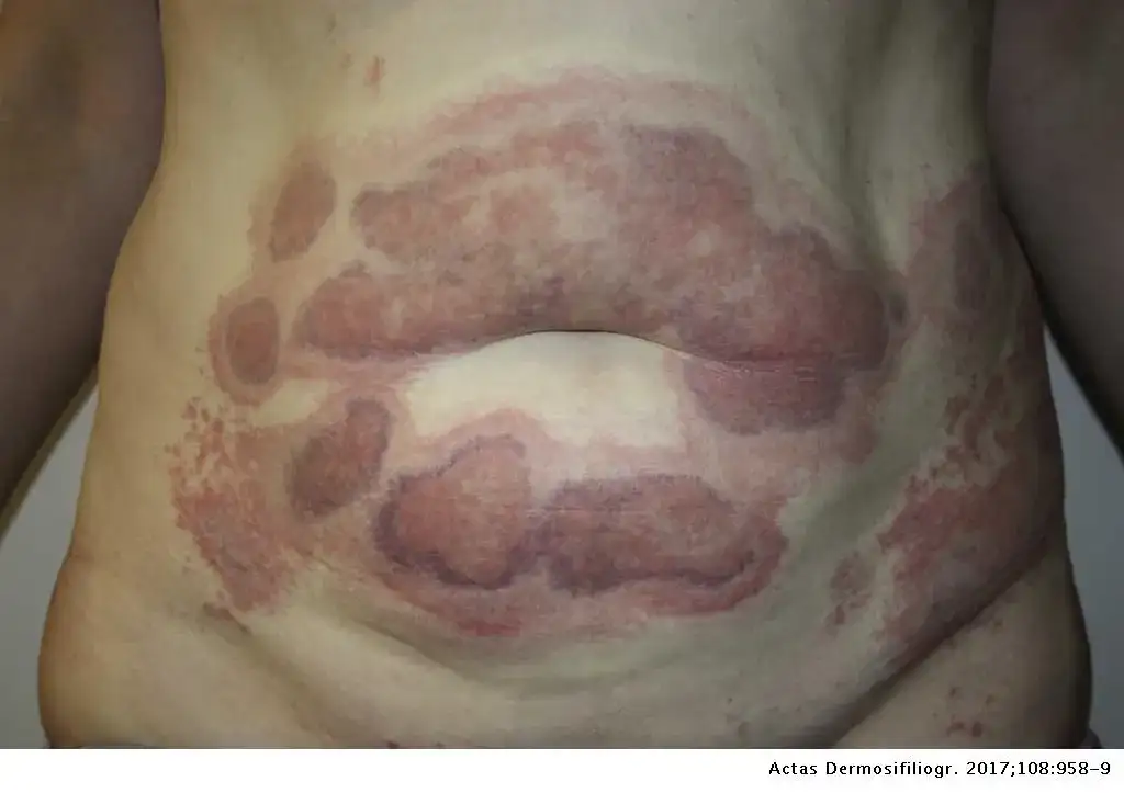 Skutki uboczne lipolizy: jak unikać poważnych zagrożeń i objawów